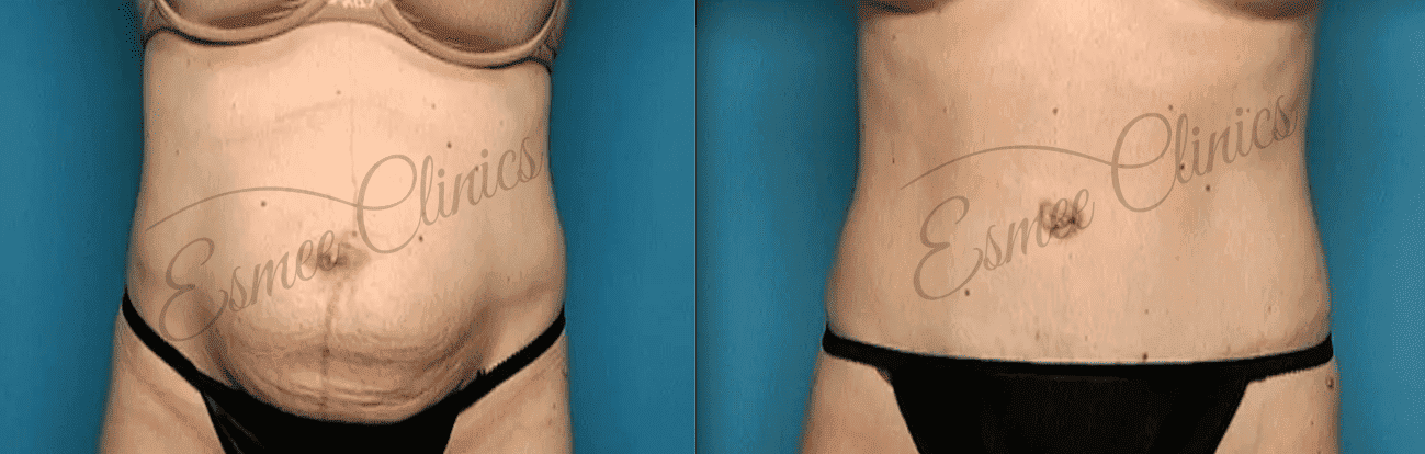 Before and After img